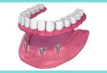 PROS AND CONS OF DENTAL IMPLANTS