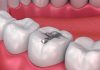 dental tooth filling in dubai