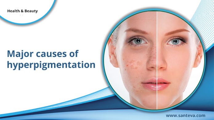 Major causes of hyperpigmentation