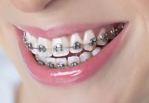 dental braces in dubai