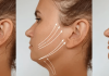 what are the advantages of thread lift treatment
