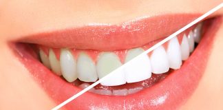 Teeth whitening London Ontario